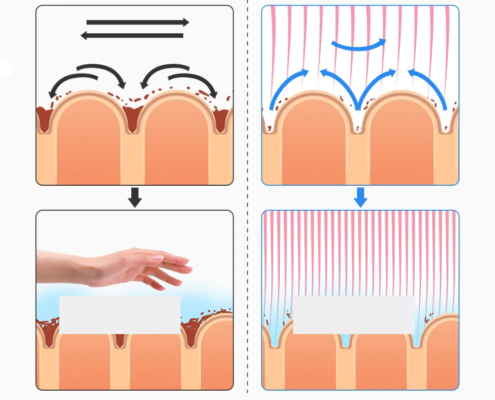Spinnenadern (Varizen)