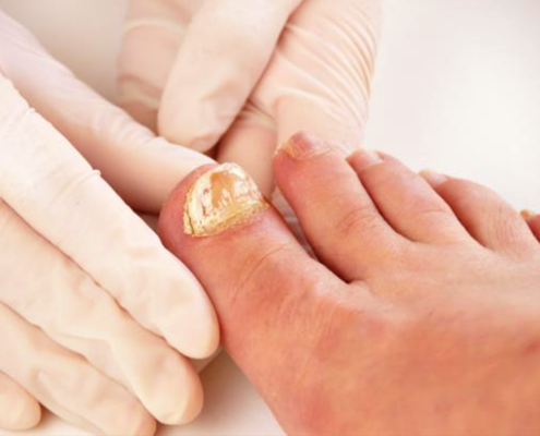 NAGELPILZ NATÜRLICH BEHANDELN