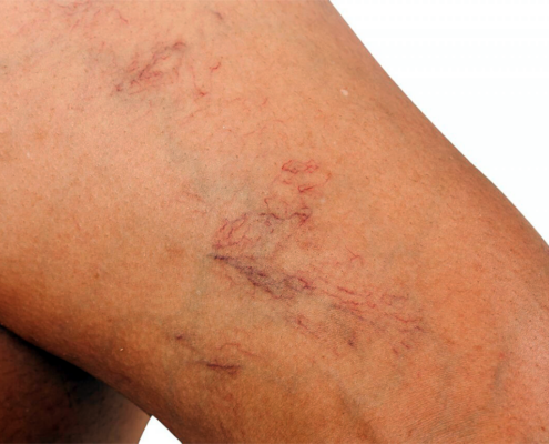 SPINNENADERN (VARIZEN)