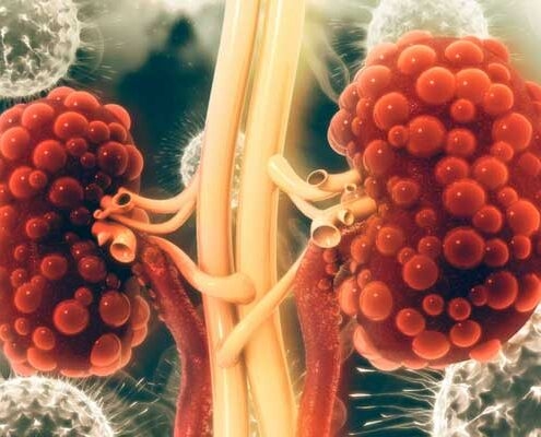 POLYZYSTISCHE NIERENERKRANKUNG