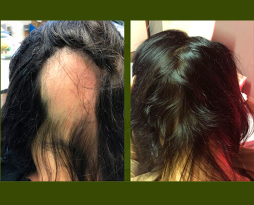 Alopecie areata Kreisrunderhaarausfall