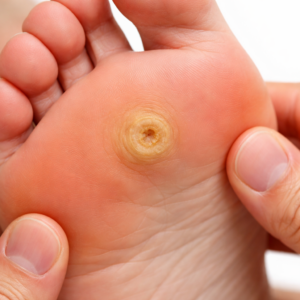 Deine natürliche Lösung gegen Hühneraugen. Headline