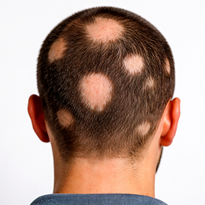 Alopecia areata
